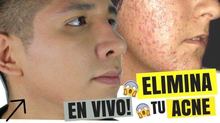 ¿Cómo deshacerse del acné de forma natural?