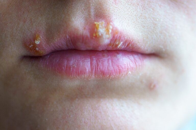Deshacerse del herpes labial de forma rápida y natural
