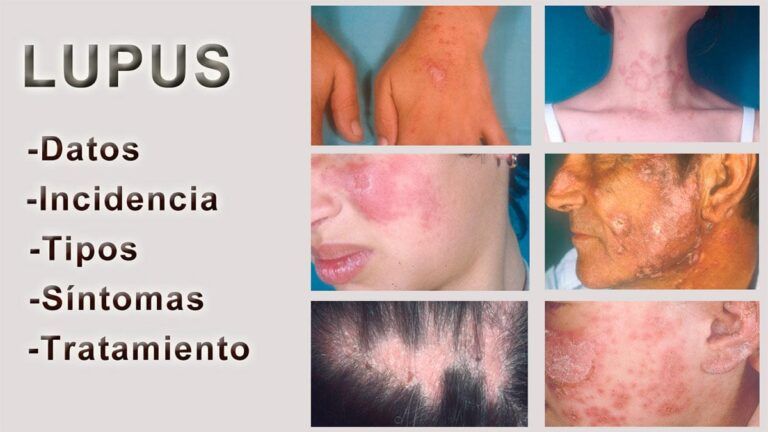 Lupus: centrarse en síntomas, causas y tratamientos