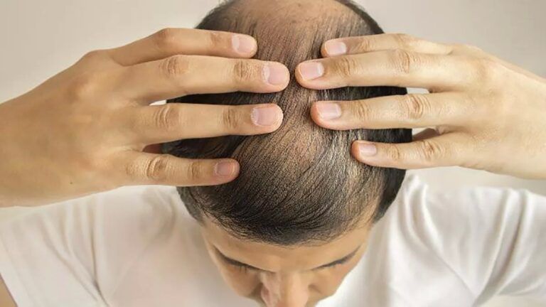¿Cuáles son los hechos sobre Propecia y otros tratamientos contra la caída del cabello?