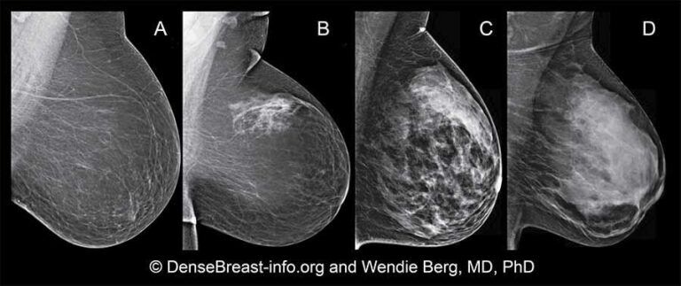 ¿Los senos densos representan riesgos para la salud?