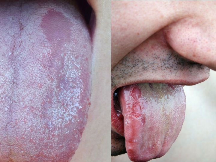 Remedios caseros para el picor de la lengua