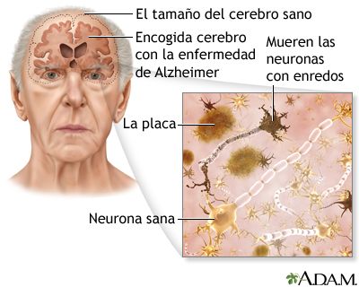 Información sobre la enfermedad de Alzheimer