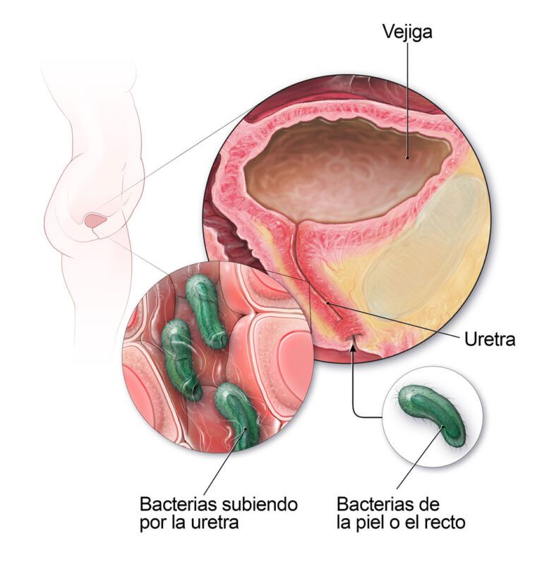 Las causas de las infecciones del trato urinario en las mujeres
